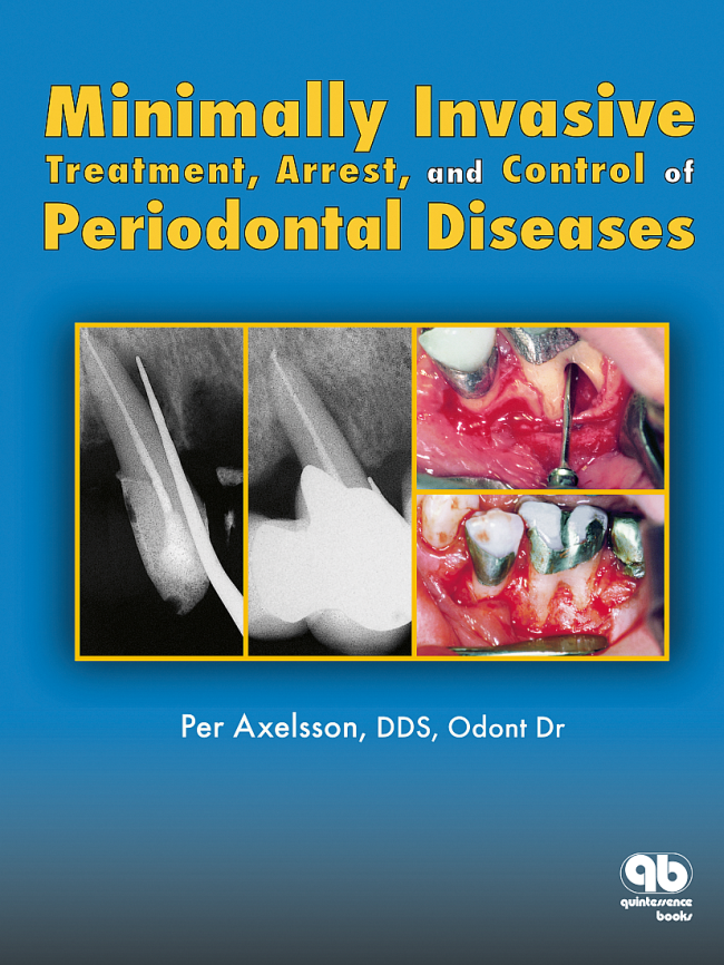 Axelsson: Minimally Invasive Treatment, Arrest, and Control of Periodontal Diseases