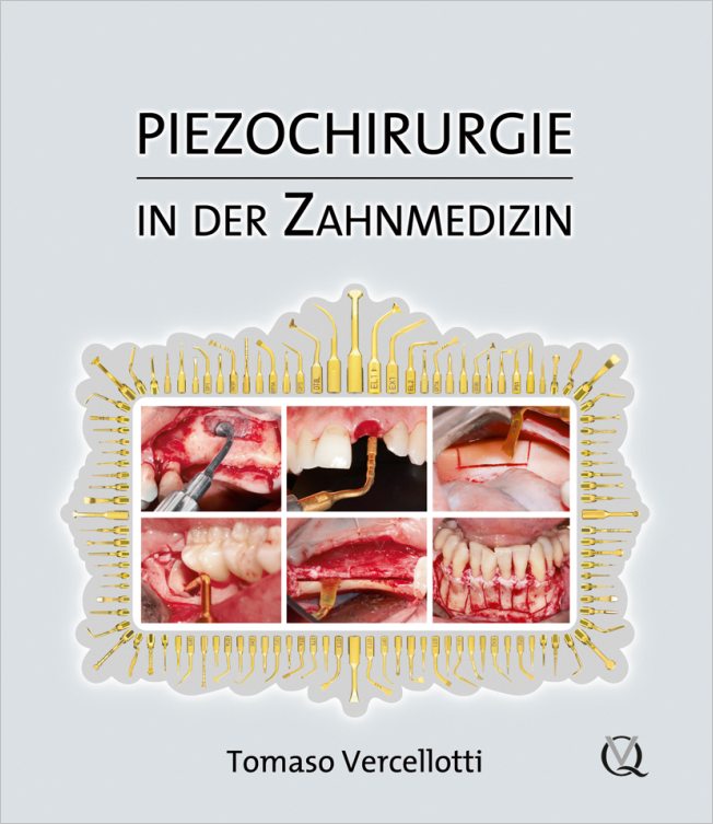 Vercellotti: Piezochirurgie in der Zahnmedizin