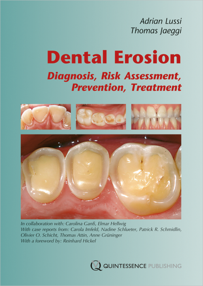Lussi: Dental Erosion