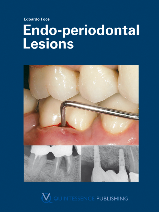 Foce: Endo-periodontal Lesions