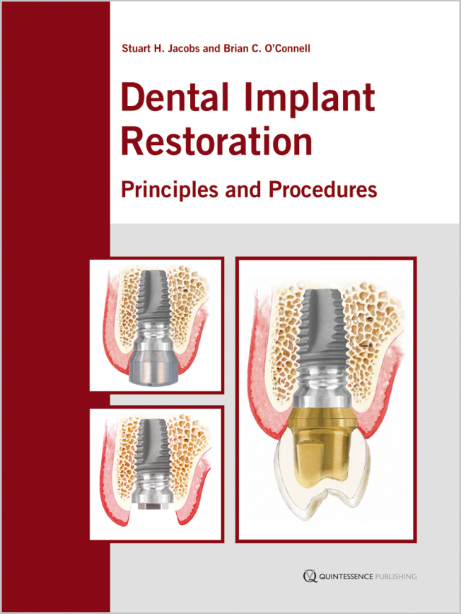 Jacobs: Dental Implant Restoration