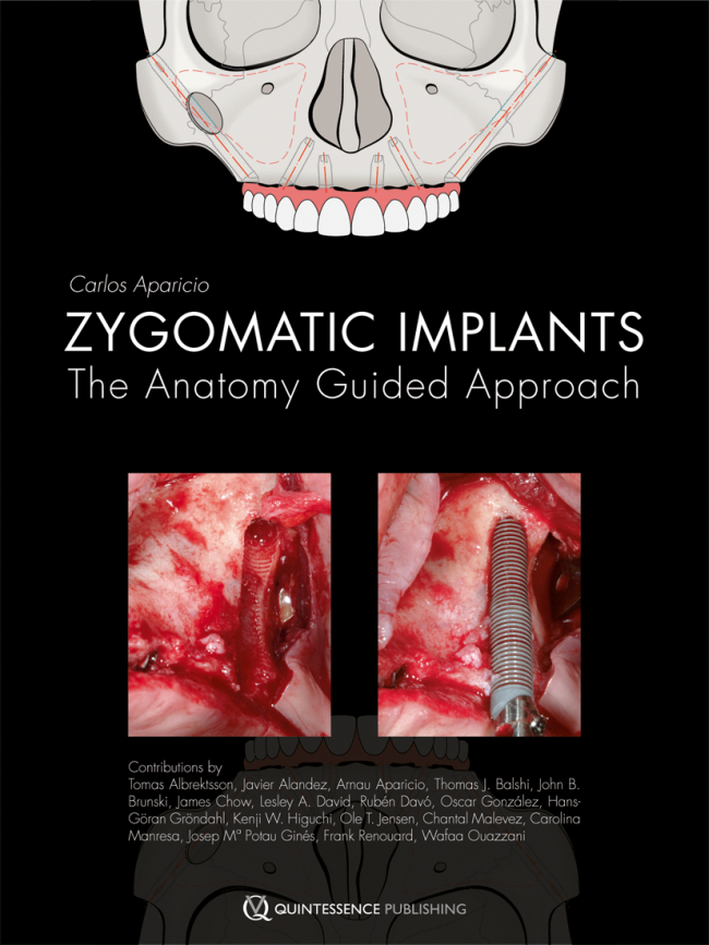 Aparicio: Zygomatic Implants