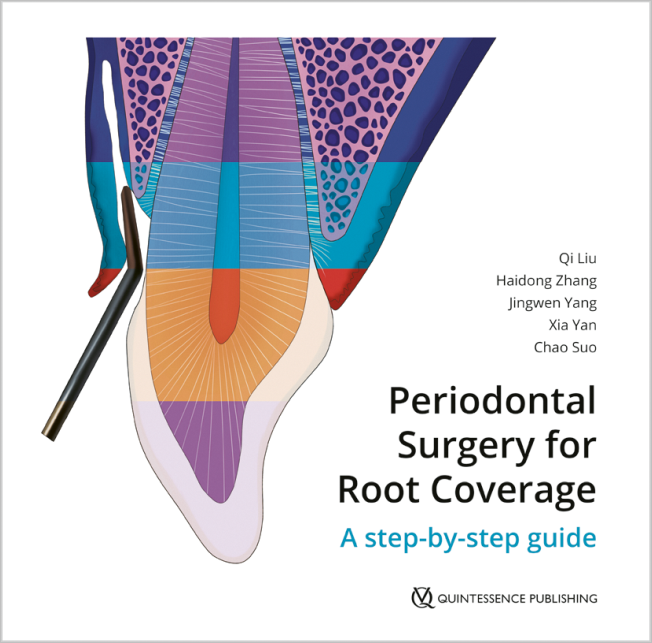 Liu: Periodontal Surgery for Root Coverage