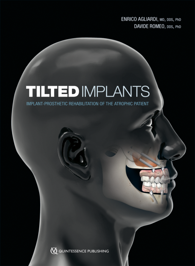 Agliardi: Tilted Implants