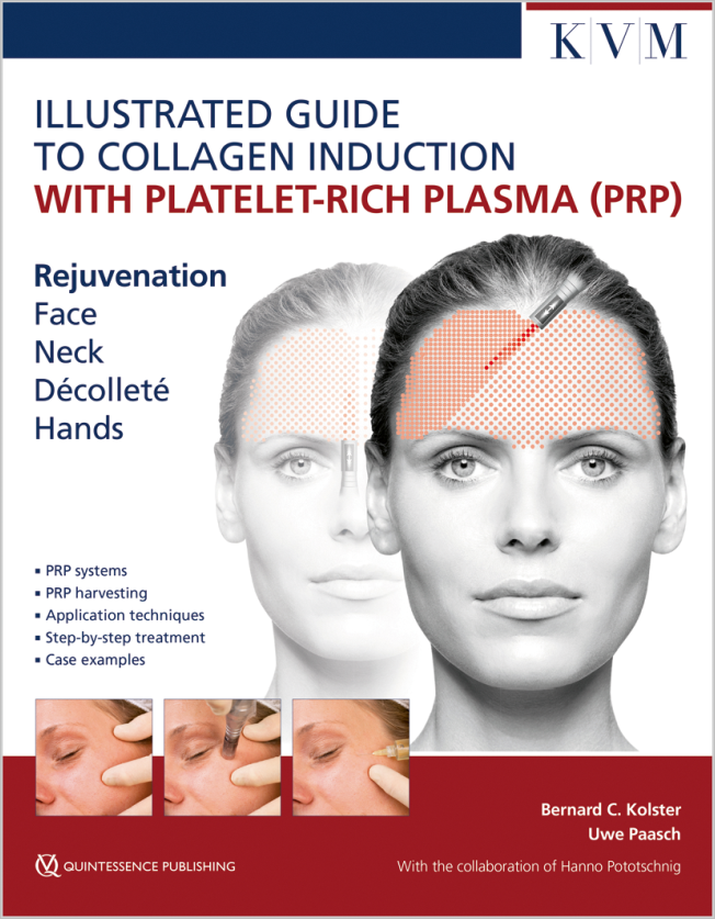 Kolster: Illustrated Guide to Collagen Induction with Platelet-Rich Plasma (PRP)