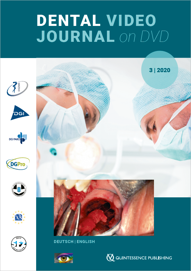 (DGZMK): Dental Video Journal 3/2020